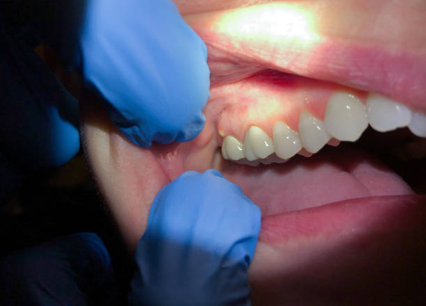 Best Emergency Dental Extractions in Wink, TX